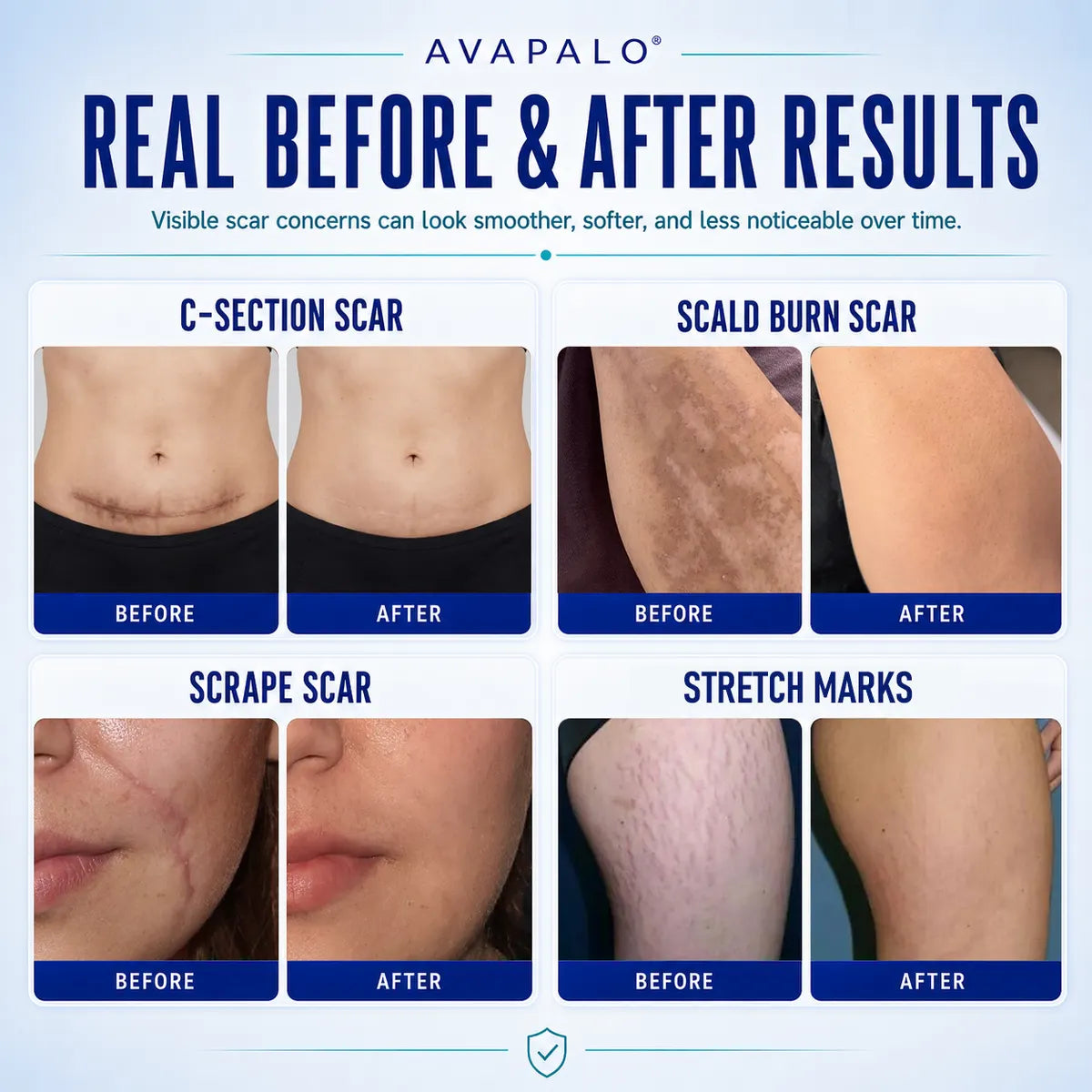 Avapalo® Advanced Silicone Scar Gel – Professional Scar Removal Cream for Surgical Scars, Keloids, Stretch Marks, C-Section & Old or New Scars Repair Treatment