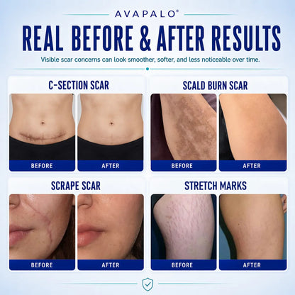 Avapalo® Advanced Silicone Scar Gel – Professional Scar Removal Cream for Surgical Scars, Keloids, Stretch Marks, C-Section & Old or New Scars Repair Treatment