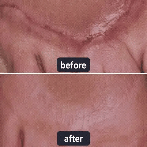Avapalo® Advanced Silicone Scar Gel – Professional Scar Removal Cream for Surgical Scars, Keloids, Stretch Marks, C-Section & Old or New Scars Repair Treatment